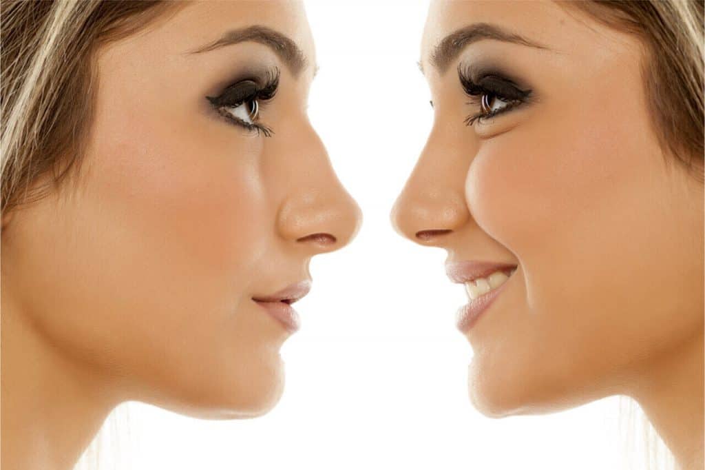before and after rhinoplasty