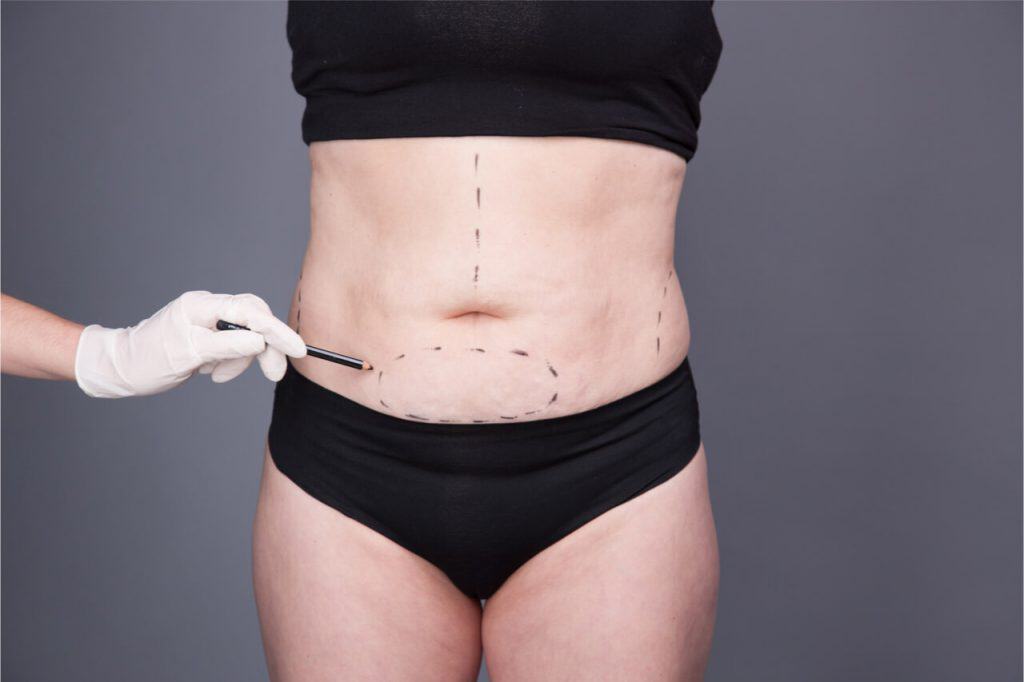 tummy tuck after pregnancy