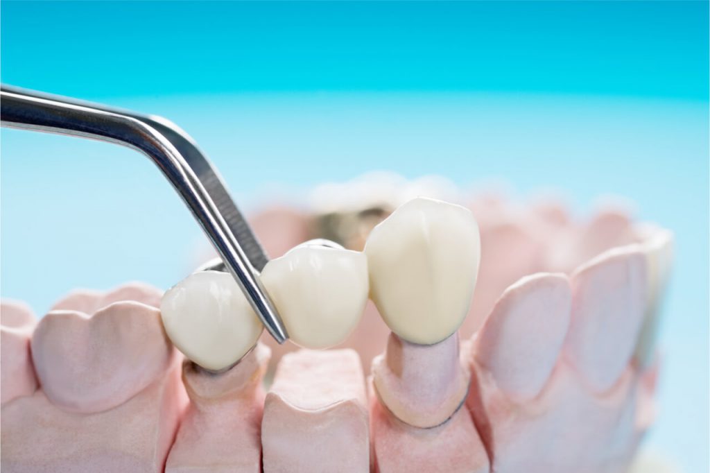 dental bridge sample