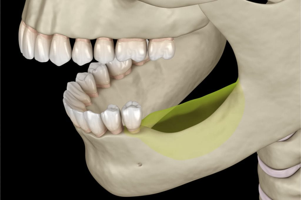 losing jaw bone